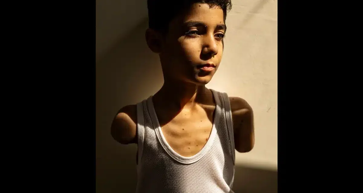 World Press Photo, il bambino mutilato a Gaza è lo scatto dell’anno